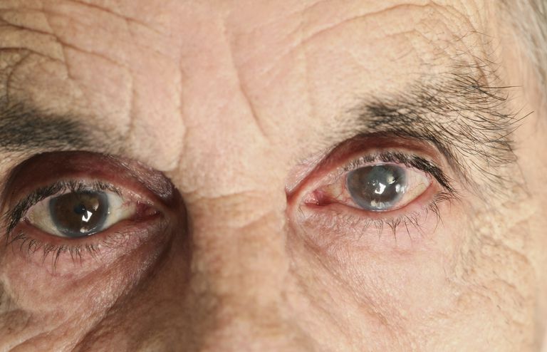 گلوکوم؛ بیماری که بی سر و صدا سراغتان می‌آید +زمان اندازه گیری فشار داخل چشم