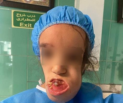 شاهکار پزشکان ایرانی: جراحی منحصر به فرد دختر 11 ساله در بیمارستان مفید